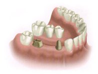 Multiple Tooth Implant