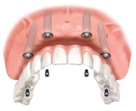 Full Tooth Implant